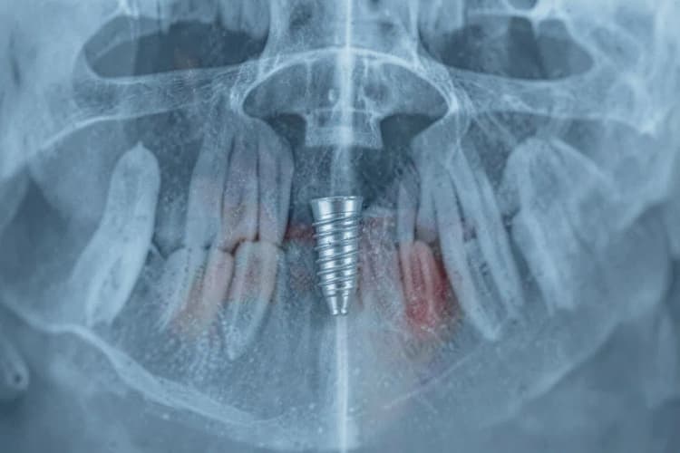 Radiografia mostrando um implante dentário recém-colocado no osso maxilar, com leve inchaço visível na gengiva ao redor.