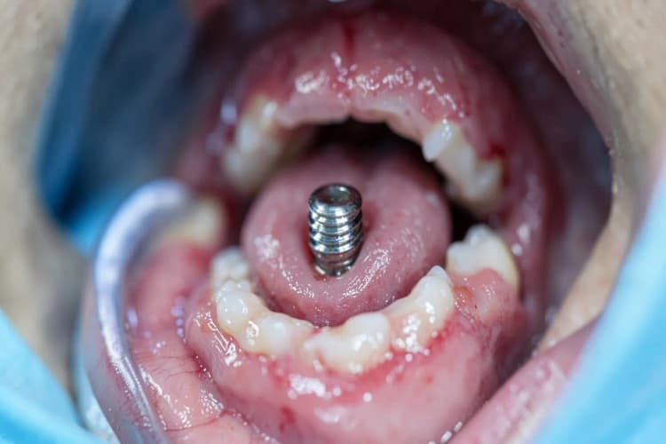 Boca aberta mostrando a área de um implante dentário com gengiva levemente inchada e avermelhada.