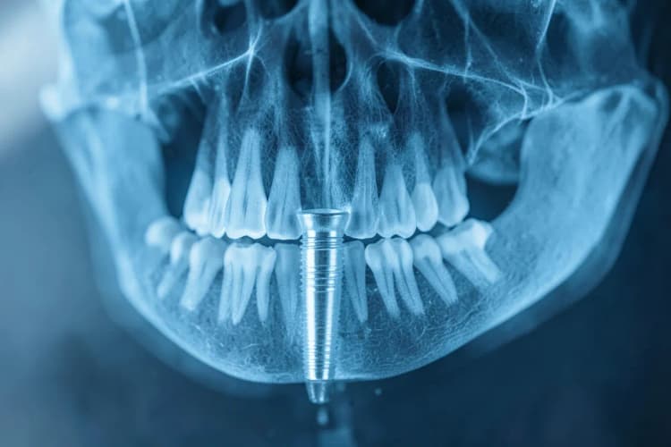 Raio-X 3D mostrando a estrutura óssea da mandíbula e um implante dentário.