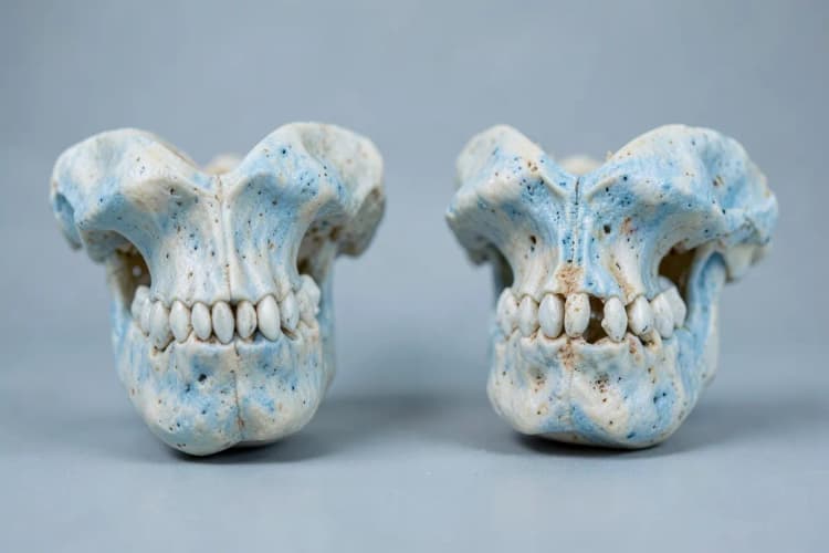 Comparação lado a lado de uma mandíbula com osso suficiente e outra com perda óssea.
